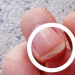 Onycholysis - layering of nails can be cured with folk remedies. We treat nails at home.