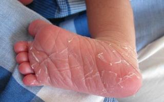 У ребенка трескается кожа на пальцах рук