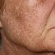 Ungüentos para manchas de la edad: en la piel de la cara, cuerpo, manos, revisiones.