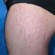 How to get rid of stretch marks on the skin How effective are creams and ointments for stretch marks?