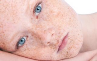 Skin pigmentation in children: normal and abnormalities