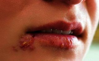 Настинка на устните: как бързо да я излекувате у дома