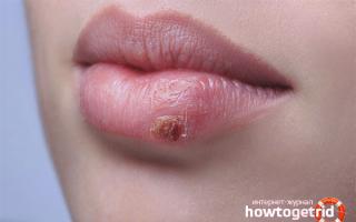 How to quickly cure a cold on your lip
