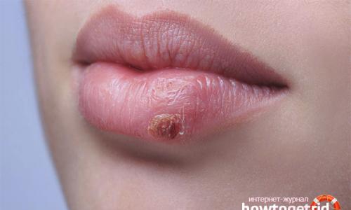 How to quickly cure a cold on your lip